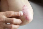 Skin disorders news, Skin disorders, five common skin disorders and their symptoms, Microorganisms