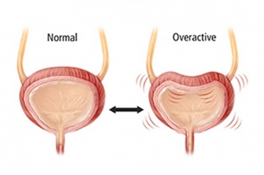 Here are Some Warning Signs of an Overactive Bladder Here are Some Warning Signs of an Overactive Bladder