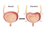 Overactive Bladder latest, Overactive Bladder signs, here are some warning signs of an overactive bladder, Alcohol