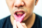 Mouth Ulcers doctors, Mouth Ulcers breaking, mouth ulcers and home remedies, Health problems Mouth Ulcers doctors, Mouth Ulcers breaking, mouth ulcers and home remedies, Health problems