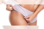 how to treat red stretch marks, red and white stretch marks, difference between red and white stretch marks explained and it s natural to have them, Stretch marks