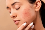 pimples, pimples, 10 ways to get rid of pimples at home, Sunscreen