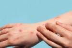 Monkeypox sexual transmission, Monkeypox, study says that the symptoms of monkeypox are different from earlier, Monkeypox