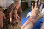 is brown henna safe, how to get rid of black henna scars, henna tattoo cause aussie woman to almost lose her hand, Hair dye