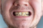 Nicotine stains research, Nicotine stains latest breaking, are nicotine stains on your teeth irreversible, Cigarette