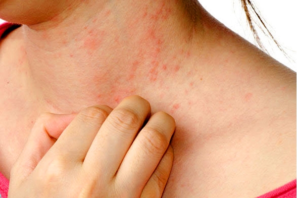 Say bye to eczema},{Say bye to eczema